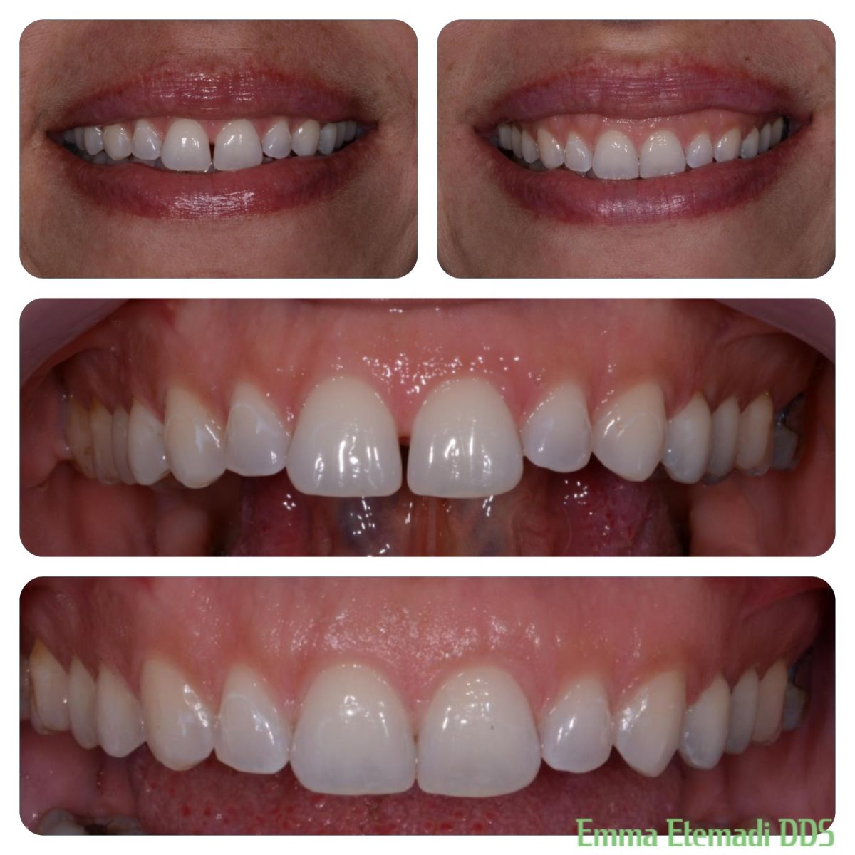 Before and After - Dentists Duvall WA | Duvall Family Dental